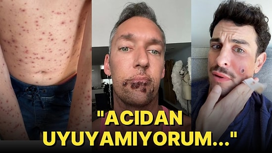 "Monkeypox" Yani Maymun Çiçeği Virüsünün Vehametini Gözler Önüne Seren Birbirinden Ürkütücü Kareler