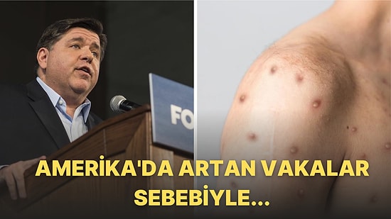 Amerika'da Kalifornia ve Illinois Eyaletlerinde 'Maymun Çiçeği' İçin Acil Durum İlan Edildi!