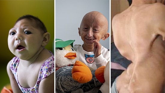 Erken Yaşlanıp Ölen Kişilerden Yeni İskelet Oluşturanlara: Bilinen En Kötü Genetik Hastalıkları İnceliyoruz