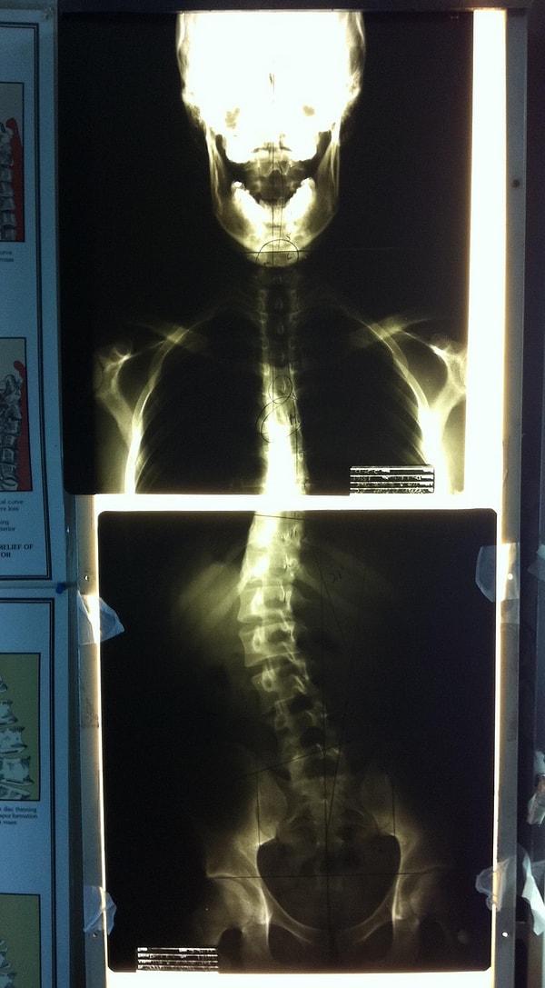 6. Omuruliği yamulmuş olan birinin röntgeni: