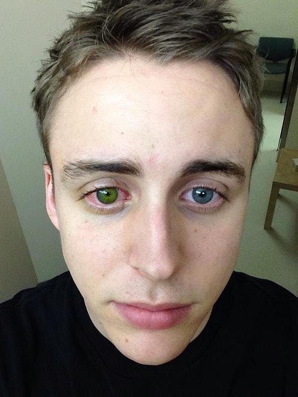 16. "Arkadaşım keratokonus ameliyatı oldu ve bir gözü artık yeşil."