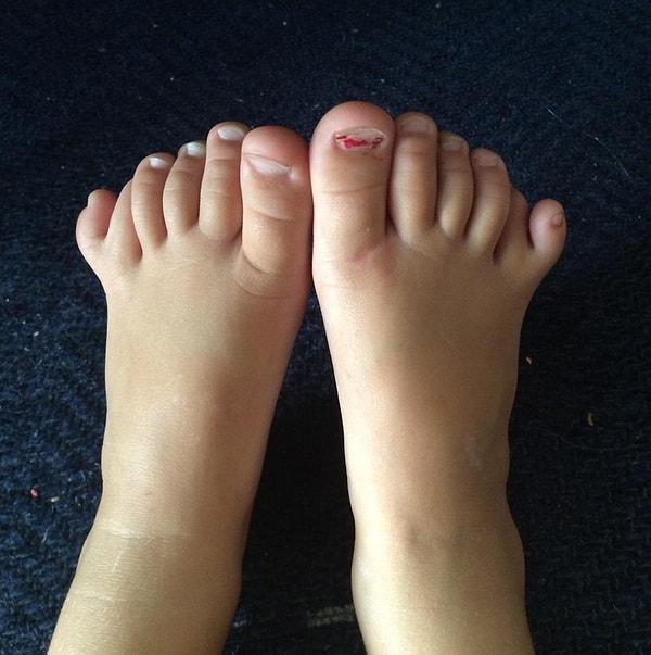 11. "Kızımın her ayağında 6 parmak var."