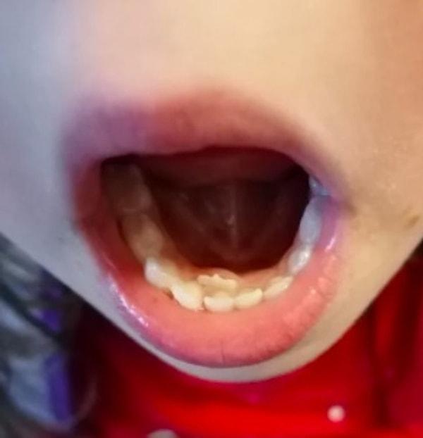 6. “Kızımın süt dişlerinin arkasından çıkan bir dişi daha var.”