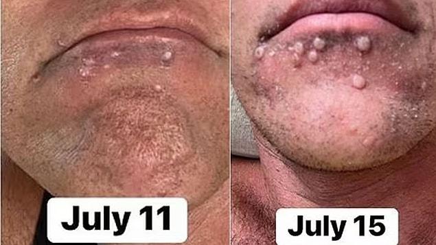 According to the news in DailMail, white pus-filled spots formed on his whole body, especially on his penis and mouth, which is bad. As a result of the test, it was revealed that he had monkeypox disease. He was hospitalized and given a range of antiviral drugs.