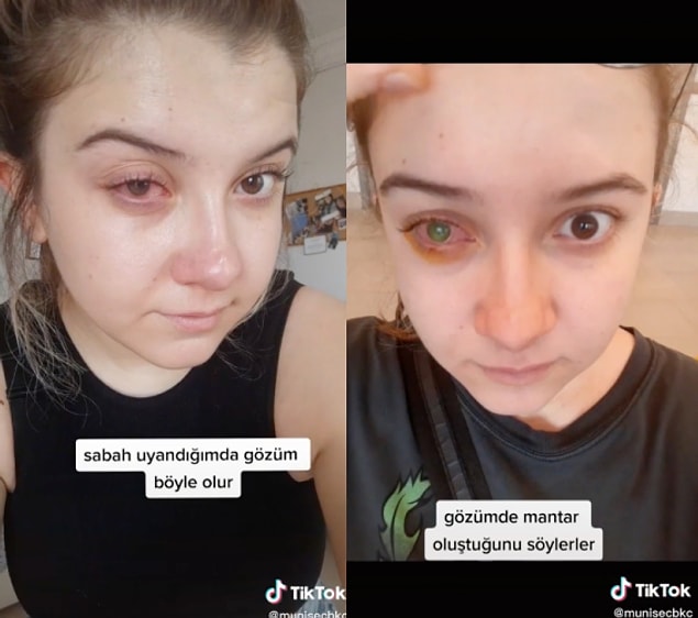 Sabah uyandığında sağ gözünün kızarmasıyla birlikte doktora giden kullanıcı, gözünün mantar kaptığını öğrenmiş ve ameliyat olarak bir tedavi sürecine girmiş.
