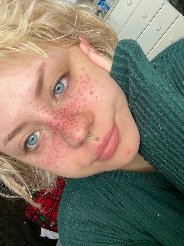 14. Они должны были быть коричневыми, но они очень красные. Пытаюсь убедить себя, что это просто воспаление, и оно пройдет