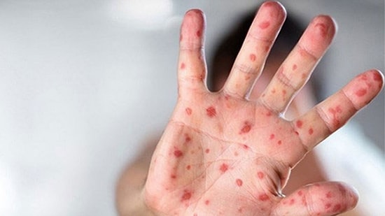 Maymun Çiçeği Vakalarında Artış Bekleniyor