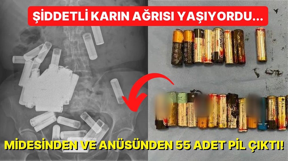 Anüsünden ve Midesinden Tamı Tamına 55 Adet Pil Çıkartılan Kadının Bilim Tarihine Geçecek Akılalmaz Hikayesi