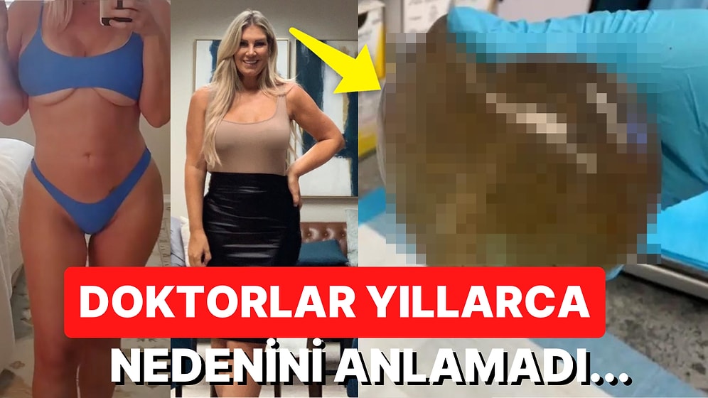 Meme İmplantı Yaptırdıktan Sonra Yıllarca Acı Çeken Kadının Başına Gelenlere İnanamayacaksınız!