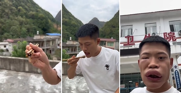 Canlı canlı yaban arısını yiyen adam hayatının en büyük dersini aldı! Ağzına attığı arı tarafından sokulan adamın yüzünün büyük bir bölümü şişti.