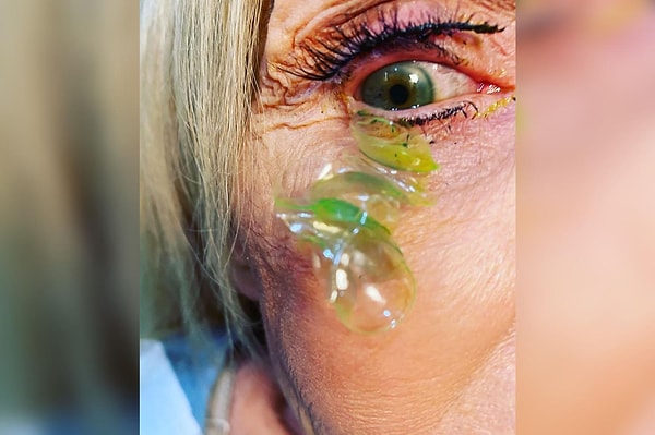Geçtiğimiz günlerde ABD’nin Kaliforniya eyaletinde akıllara durgunluk veren bir olay yaşandı. Kaliforniyalı bir göz doktoru olan Dr. Katerina Kurteeva, ağrı ve bulanıklıktan şikayetçi olan bir hastasının, gözünden 23 adet lens çıkarttı.