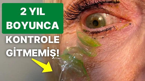 Yatmadan Önce Üşenip Unuttuğu İçin Gözünden 23 Adet Lens Çıkartılan Kadının Beyin Yakan Görüntüleri