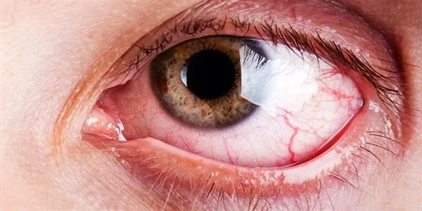 3. Gözlerimizin iç tarafında bulunan bu minik pembe kabarcık, plica semilunaris adını taşır, gözyaşı drenajı ve göz küresi hareketliliğine yardımcı olmaktan sorumludur.
