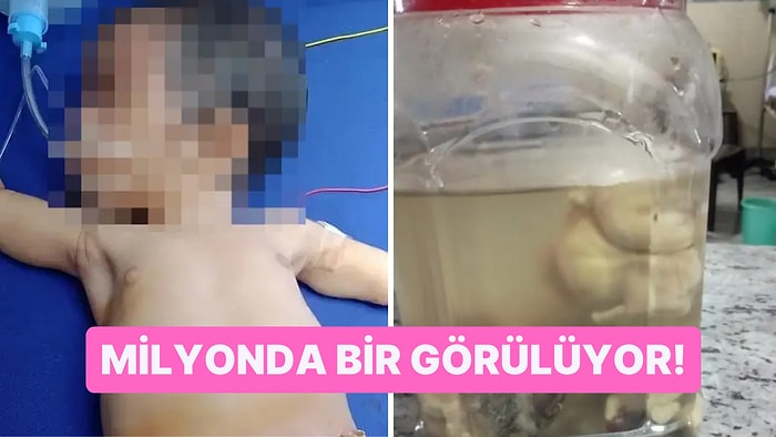 Hindistan'da Yeni Doğan Bir Bebeğin Midesinden Çıkartılanlar Gören Herkesin Kanını Dondurdu!