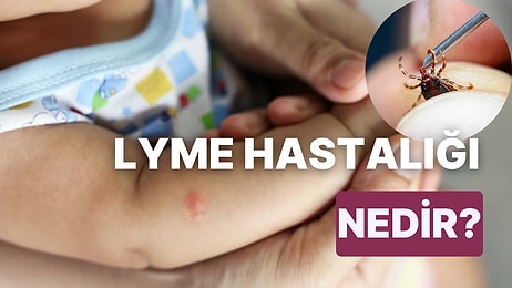 Lyme Hastalığı Nedir? Lyme Hastalığının Belirtileri Nelerdir? Nasıl Tedavi Edilir?