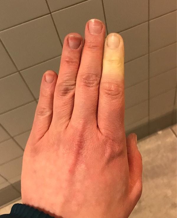 6. "Raynaud's sendromu yüzünden parmaklarımın yarısı beyazlaşıp hissizleşiyor."