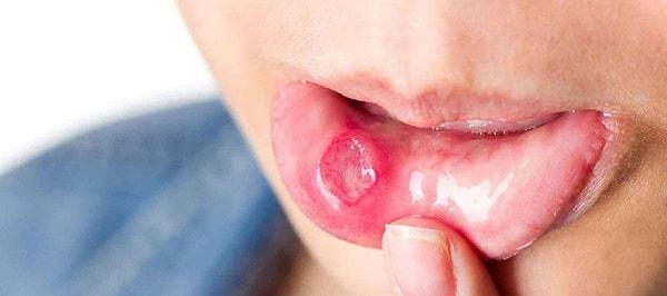 1. Ağız içinde ya da dil üzerinde, ağrılı, ortası beyaz lezyonlar oluşuyorsa...