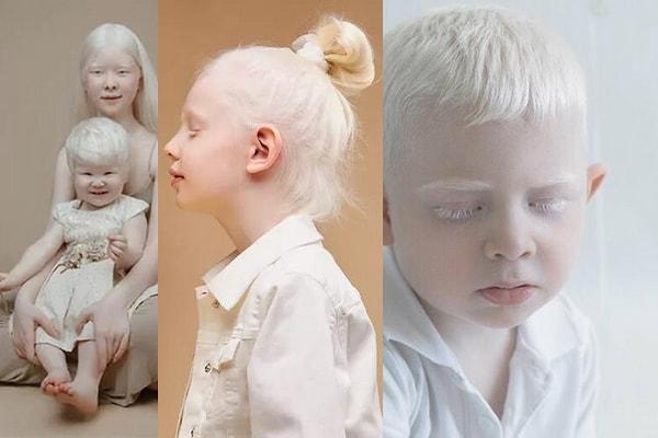 Pigmenti olmayan insanlar: Albinolar