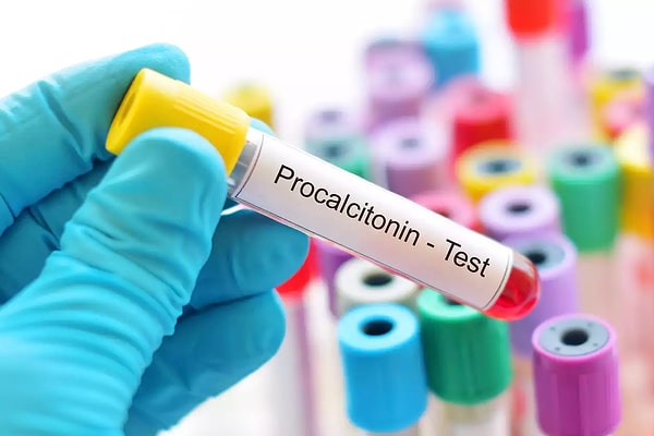 Prokalsitonin (PCT) Nedir?