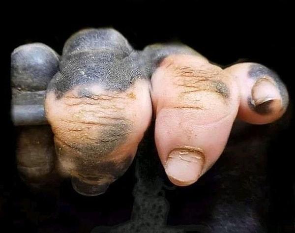 15. Pigment kaybı (vitiligo) hastalığı olan gorilin parmakları biraz fazla ürkütücü değil mi?