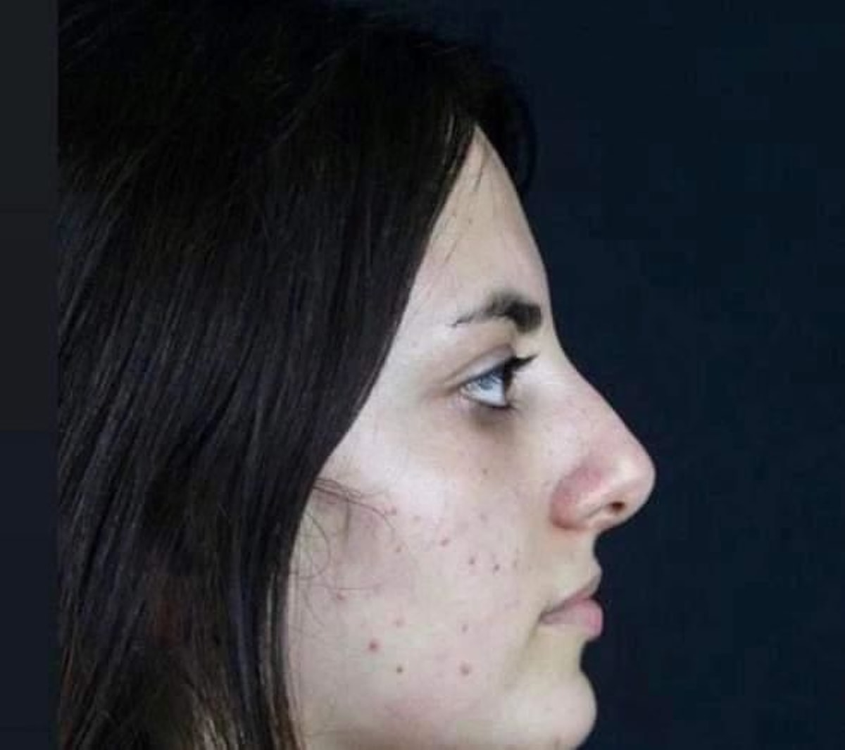 İşte Elif'in estetiksiz hali.