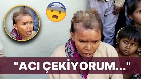 Baş Ağrısı Şikayetiyle Gitmişti: Kafasında Boynuz Çıkan Kadın Doktorları Hayrete Düşürdü!