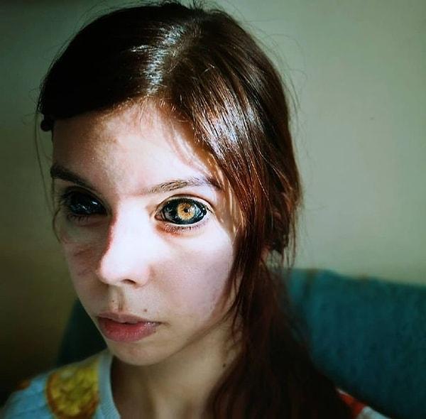 25 yaşındaki Aleksandra Sadowska, göz bebeklerine dövme yaptırdıktan sonra bir gözü tamamen kör olurken diğer gözünde de görme kaybı başladı.