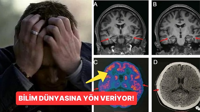 19 Yaşındaki Dünyanın En Genç Alzheimer Hastası Bilim Dünyasına Yön Verdi!