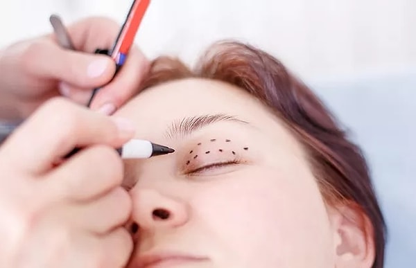 3. Blepharoplasty - Eyelid Surgery