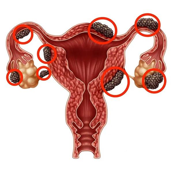 1. Endometriozis