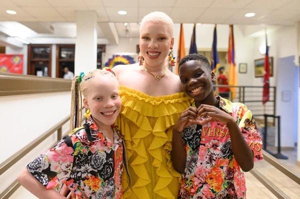 11. Florida'da yaşayan Sheriq ve Teriq isimli ikizler, Sheriq'teki albinizm rahatsızlığından dolayı tamamen farklı görünüyorlar. Sheriq, ablasıyla aynı rahatsızlığa sahip.
