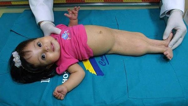 Sirenomeli olarak da bilinen deniz kızı sendromu bebeklerin kaynaşmış bacaklarıyla doğmasıyla meydana gelir.