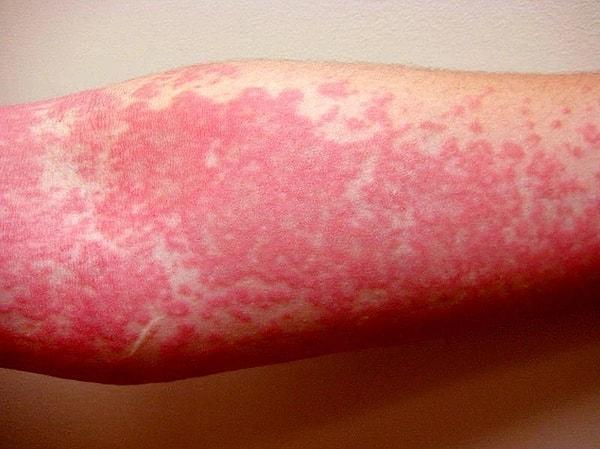 5. Su alerjisi ya da akuajenik ürtikeri olan kişilerin vücudunda sürekli kırmızı döküntüler meydana gelir.