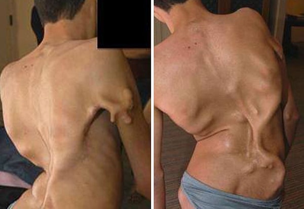 14. Существует чрезвычайно редкое состояние, называемое «Синдром каменного человека», при котором любое, малейшее повреждение, нанесенное ткани, перерастает в кость