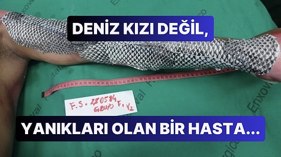 Cilt Yanıklarına Balık Derisi Tedavisinin Etkisini Görünce Gözlerinize İnanamayacaksınız!