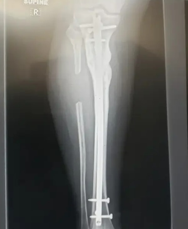 5. «Вокруг этого снимка собрались все врачи клиники, и никто не мог понять, куда делась часть моей малоберцовой кости»