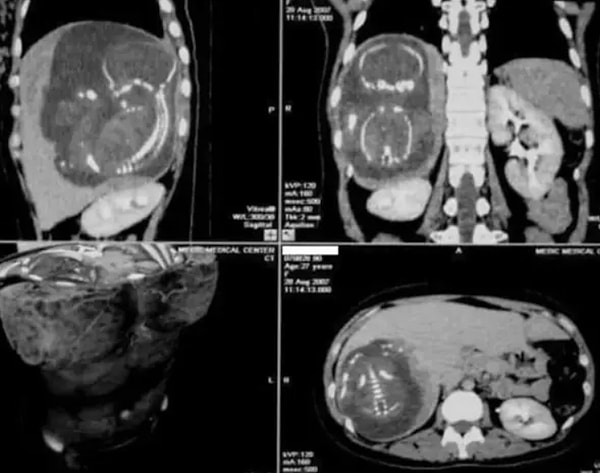 17. «Сегодня я узнала, что эмбрион может прикрепиться к печени и просто... и у вас будет внематочная беременность прямо около печени»