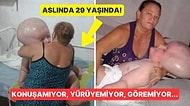Aslında 29 Yaşında: Son Derece Nadir Görülen Bir Hastalığa Sahip Olduğu İçin Kafası Sürekli Büyüyor!