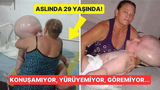 Aslında 29 Yaşında: Son Derece Nadir Görülen Bir Hastalığa Sahip Olduğu İçin Kafası Sürekli Büyüyor!