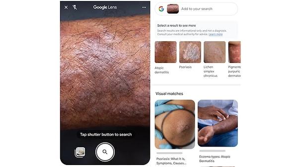 Kişiler, Google Lens sayesinde cildinin sorunlu bölgesine ait bir fotoğraf ile arama yapabilecek ve internetteki benzer görseller ve doğruluk payı yüksek yorumlarla daha sağlıklı fikirler edinebilecek.