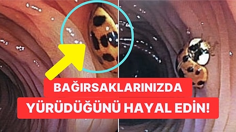 Kolonoskopi Sırasında Kalın Bağırsağında Uğur Böceği Gezinen Adamın Görüntüleri Akıllara Durgunluk Verdi