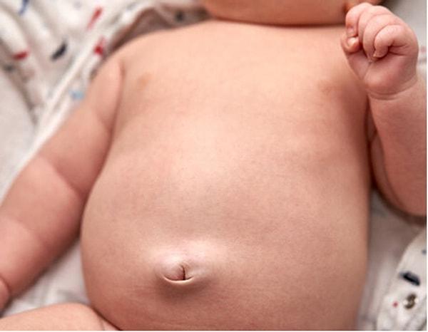Göbek deliği şişmesi de bebeklerde oldukça yaygın. Göbek deliği etrafındaki bu şişliğin nedeni doğum sonrası göbek kordonunun kesilmesiyle kalan dokunun iyileşme sürecinde oluşturduğu tepki.