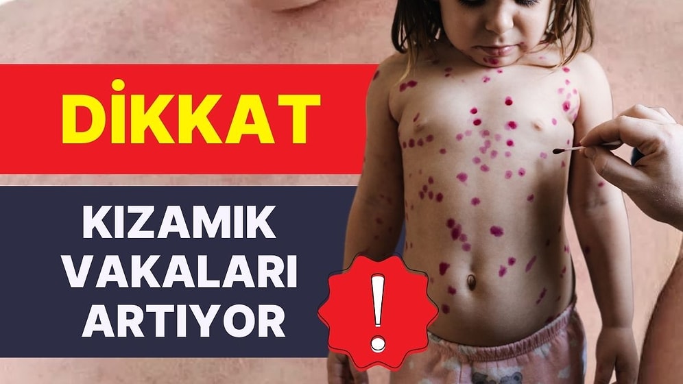 İstanbul’da ‘Kızamık’ Vakaları Yoğunlaştı: “Okullar Açıldığında Kızamık Daha da Artacak”