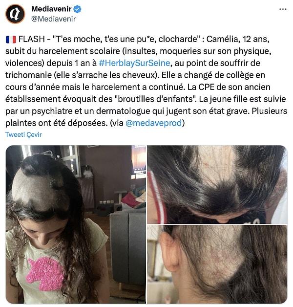 Twitter'da @forensicmedmd adlı bir doktor, @Mediavenir adlı bir sayfanın paylaştığı Fransızca metinli paylaşımı yorumladı. Paylaşımda 12 yaşındaki Camélia adlı bir çocuğun fiziksel görünümü nedeniyle okul arkadaşları tarafından hakaret ve şiddete uğradığı yazılıyor.
