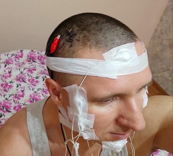 İnternette beyin cerrahlarının operasyon videolarını incelediğini söyleyen Raduga, 19 Haziran tarihinde ev tipi bir matkap kullanarak kafasına delik açtı!