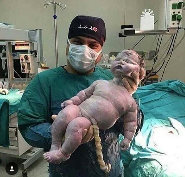 Geçtiğimiz aylarda, Brezilya'nın Amazonas eyaletinde 7 kilo ve 57 santim, nur topu gibi bir bebek dünyaya gelmiş,