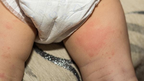 Besin alerjisi riskini azaltmak için, bebeklere potansiyel alerjen gıdaları tek tek ve yavaş yavaş tanıtmak önemlidir.
