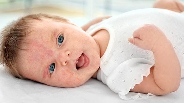 Bebeklerde yumurta alerjisi belirtileri nedir?