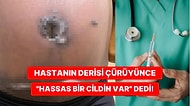 Diyabet Hastası Kadın, Doktoru Tarafından Bilgilendirilmeden Estetik Ameliyat Geçirince Derisi Çürüdü!