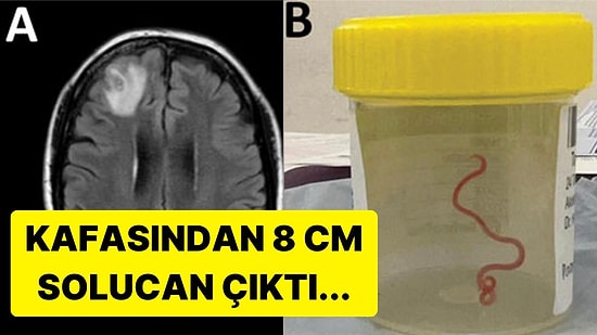 64 Yaşındaki Kadının Beyninden Sadece Pitonlarda Bulunan Canlı Solucan Çıktı